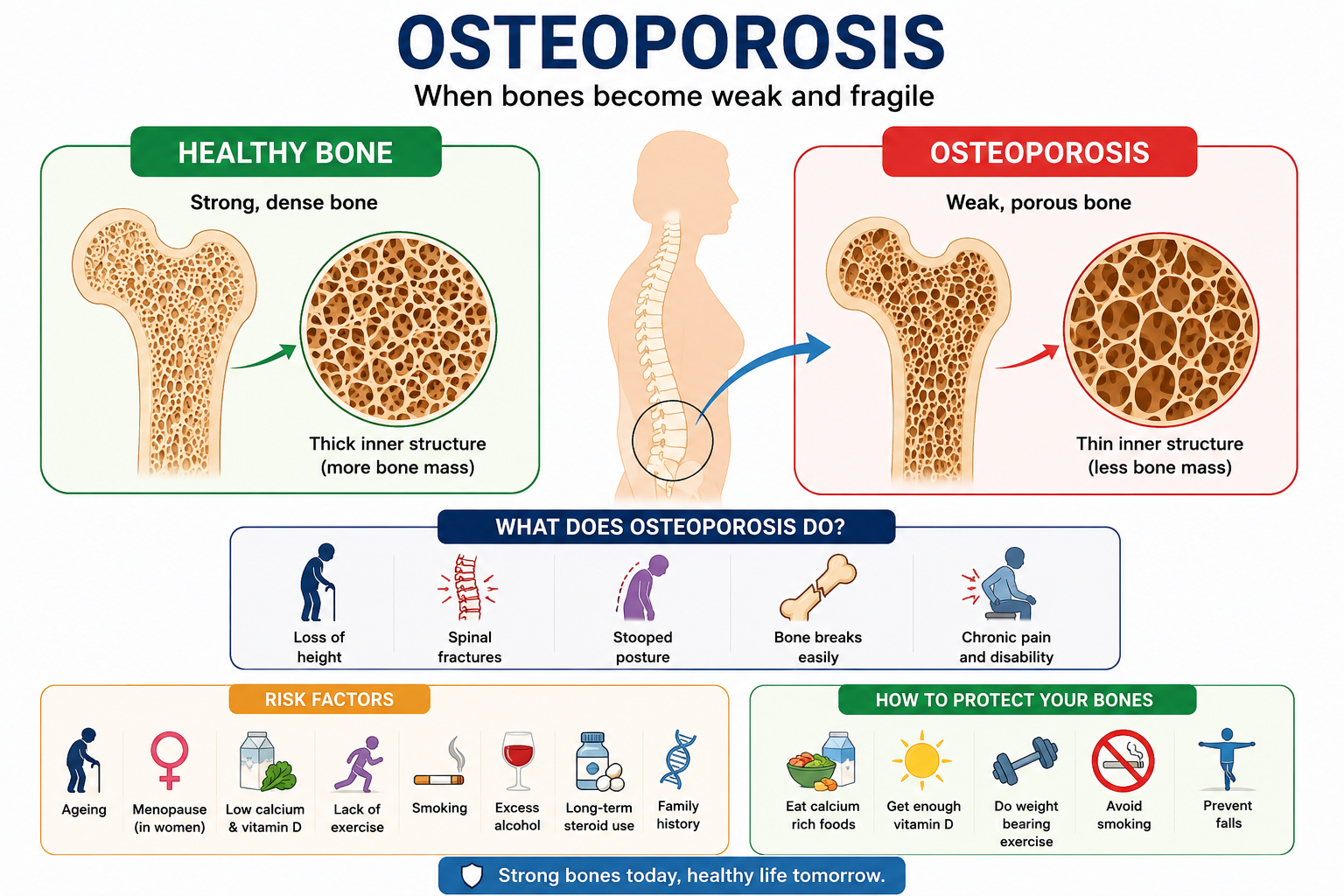 Start walking to treat osteoporosis yourself